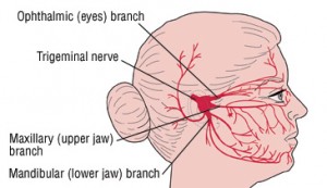 Trigeminal neuralgia